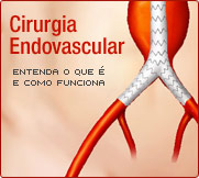 O que é Cirurgia Endovascular